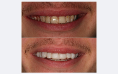 Professional Teeth Whitening London | FAQs at Levitas Dental