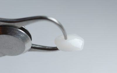 Porcelain Veneers in London & Surrey : A Complete Guide to Your Perfect Smile